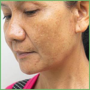 Skin pigmentation and lack of vitamin b12